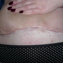 Day 40 - 5 and half wks - pulling my skin up so you can see the cut better by which the upward curve tells you there's still skin hanging around