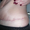 Day 40 - 5 and half wks - pulling my skin up so you can see the cut better, again dragging more skin upwards.  I'm sure it should be taut, it is on others and what I was told I would be "taut and tight"