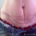16 weeks post op