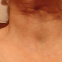 Post op 3 wks