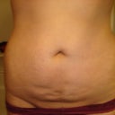 Front- 6 months post op