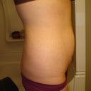 Right side - 6 months post op