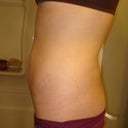 Left side - 6 months post op