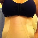 10 days post op w/garment