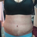 2 weeks!  dissolvable stitches, no drains