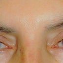 Before - Nov 16 minutes before surgery