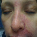 Cellulitis and staph infection in face. This is after 3 days in the hospital