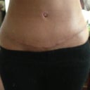 Exactly 1 month post op!