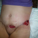 here you can see the depth of the wounds =(  going to take 3-4 weeks with a wound vac to heal up