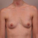 Breast Implants