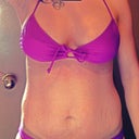 48 Hours After Pic (Same swim suit as before). The marks you see on my hips is tape from my incision.