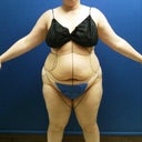 Preop photo with markings