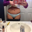 (dont look at my dirty bathroom I just had surgery and this has been neglected lol) But I can almost stand up straight and even though I am really swollen (my sides are really bad) you can see my future flat tummy! Day 12 post op
