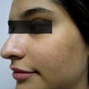 23 Year Old Acne Patient