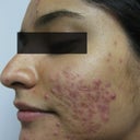 23 Year Old Acne Patient