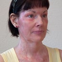 I had also developed a rash or outbreak on my neck and chest about 2 weeks after the procedure