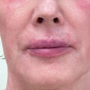 I developed some kind of blister around my mouth at 3 weeks post.