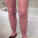 My legs were vivid purple - not a rash - a sign of toxic staph infection