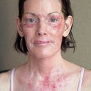 Day 10 Post - Staph infection left my lasered skin raw