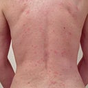 I developed atopic dermatitis - my rash at one week is MUCH worse than pictured here just after it erupted
