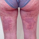 Rash on Back of Thighs