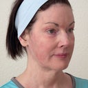 Right Side - 9 Weeks Post. I am still blotchy all over my face.