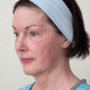 Left Side - 9 Weeks Post. I have to wear lots of makeup to cover up my blotchy, red face.