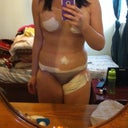 Still very swollen! 10 days po