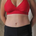 1 year post op.