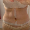 post op day 14