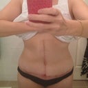 post op 4 weeks