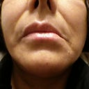 Notice my mouth is out of center when they ask me to come to see the manager she called a "doctor"(one that is not even in the page of doctor of that office) He said the mouth will be on place after a while It is been 3 month and the only change I see is my cheeks are saggier, new line and deeper lines are forming and my money is dissapearing every month paying for the high life of this crooks.