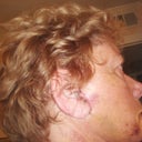 day 8  soo much better  Will update later today after stitches come out