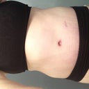 5-weeks post-op