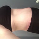 5-weeks later, still showing swelling, but healing nicely!