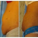 5 day post / 14 day post side