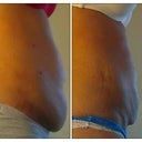 5 day post / 14 day post other side
