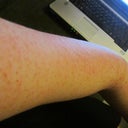 After my 2nd treatment. As you can see not NEARLY as many and as dark.