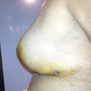 16 days post op