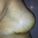 16 days post op