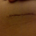 Extreme close up of me holding up the scar - 8 weeks