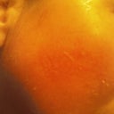 3 days post peel. 