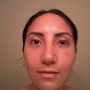 After-11 days after surgery (My nose looks very swollen but even)