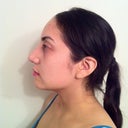 After-2 weeks (side view)