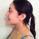 After-2 weeks(side view while smiling, I love how my tip doesn't drop)