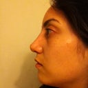 After-4 weeks (side view, the tiny bump on my tip is just a pimple)
