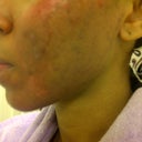 Day 3/ Premature peel of dead skin