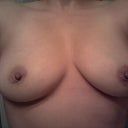 6 moths post op