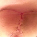 Under right breast. 21 days. Spot finally closed