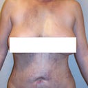 swelling and bruising after initial surgery